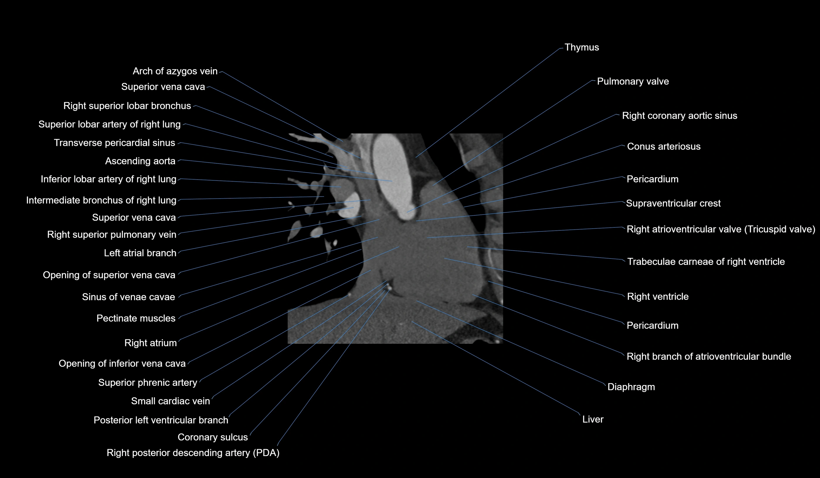 CT heart (coronary angiogram) 2 chamber view cross sectional anatomy labelled radiology image-00028.webp